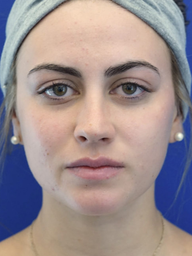 Smooth Dorsal Contour — After