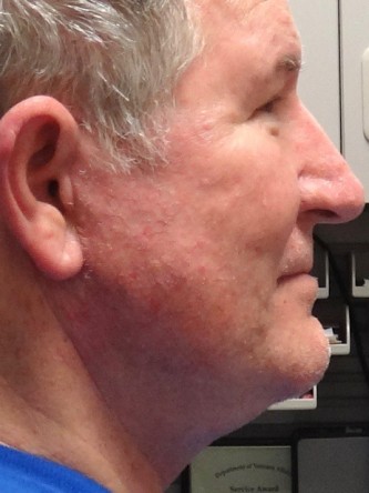Aging Eyelid Rejuvenation, Facelift, Necklift 1* — After