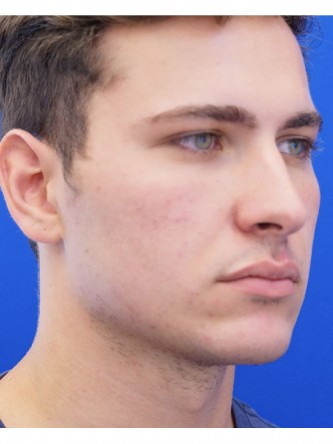 Buccal Fat Excision — Before