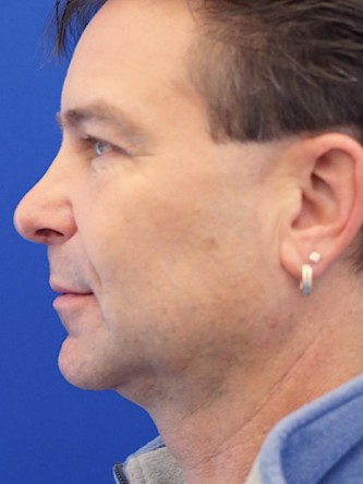 Nasal Tip Droop* — After