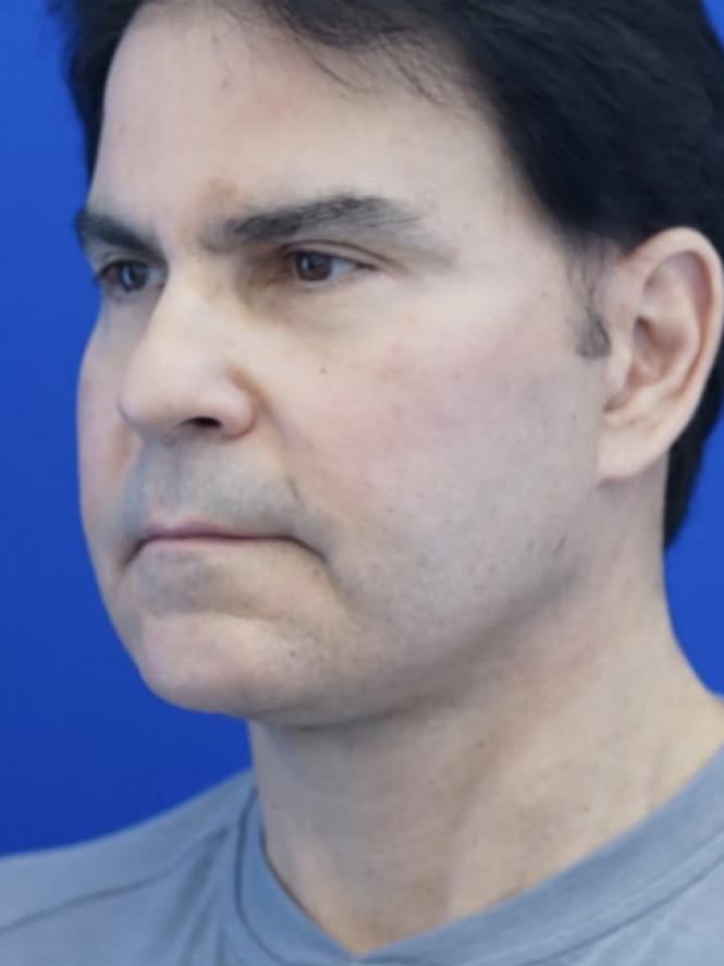 Male Facelift — After