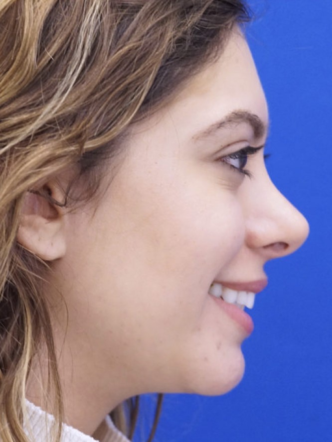 Hump Reduction and Chin Projection — After