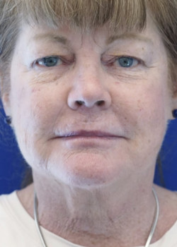 Surgical Neck Lift — Before