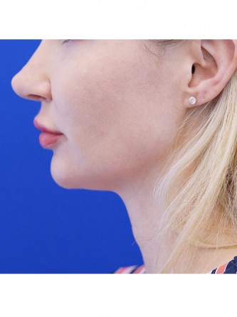 Finesse Tip Rhinoplasty — After