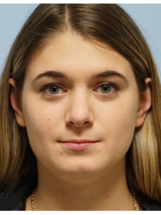 Droopy Tip Endonasal Rhinoplasty* — After