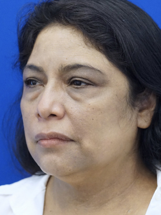 Four-Lid Blepharoplasty — Before