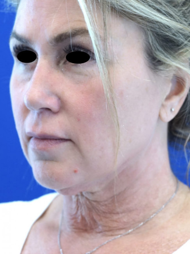 Deep Plane Facelift with Platysmaplasty — Before