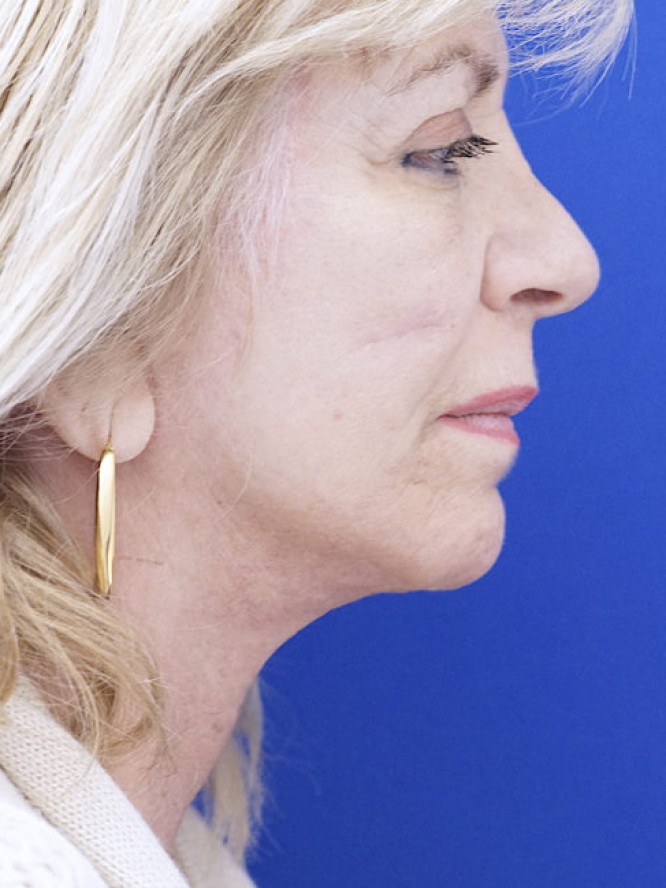 Jowls and Loose Neck Skin — After