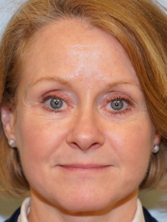Lower Eyelid Excess Fat Pad1* — After