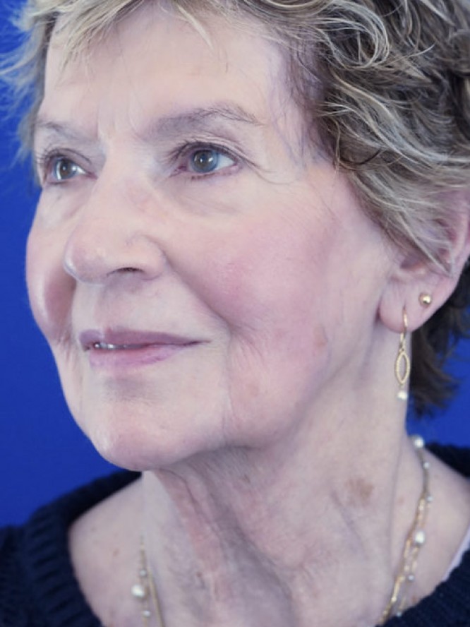Deep Plane Facial Rejuvenation — Before