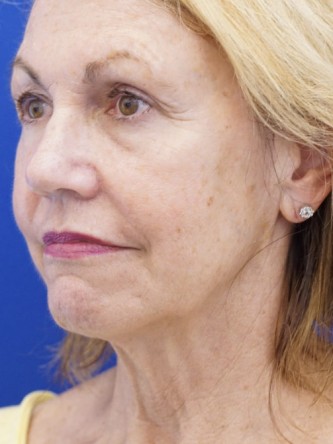 Deep Plane Lift and Superficial Laser — Before