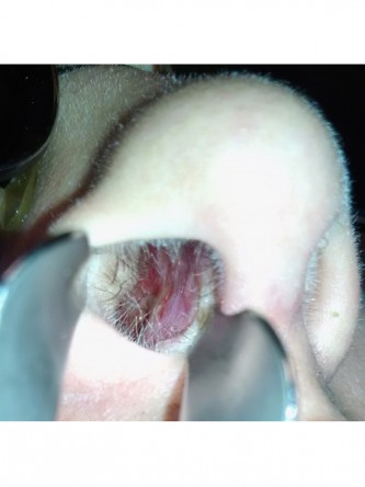 Nasal Septal Perforation3* — After