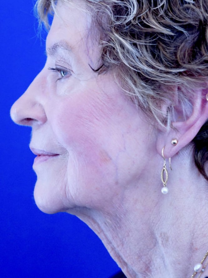 Deep Plane Facial Rejuvenation — Before