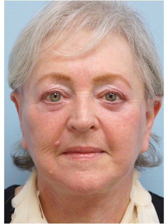 Aging Eyelid, Facelift, Necklift, Fractional CO2 Laser Resurfacing* — After