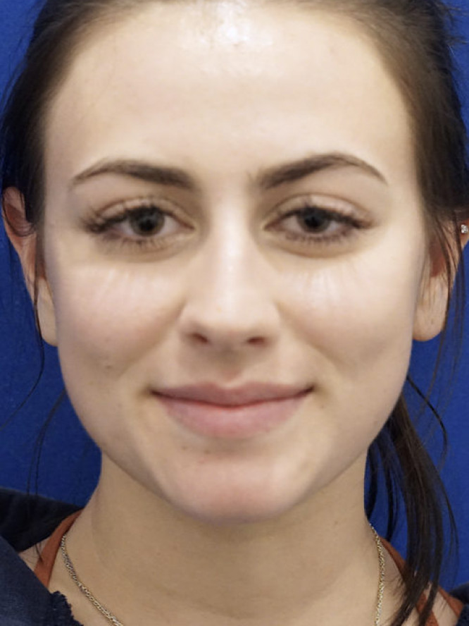 Smooth Dorsal Contour — Before