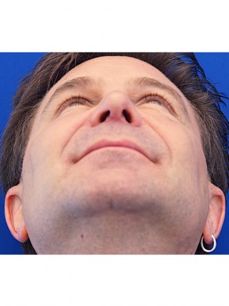Nasal Tip Droop* — After