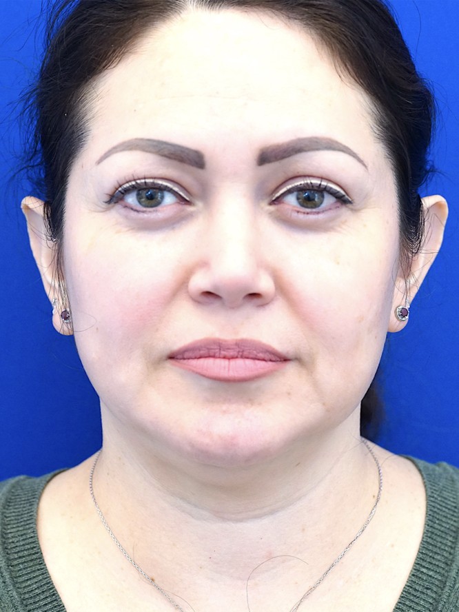 Nasal Tip Asymmetry — After