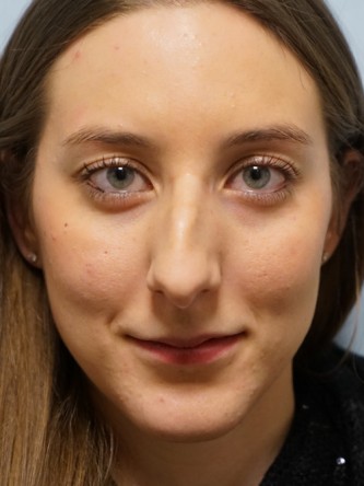 Nasal Hump Endonasal Rhinoplasty* — Before
