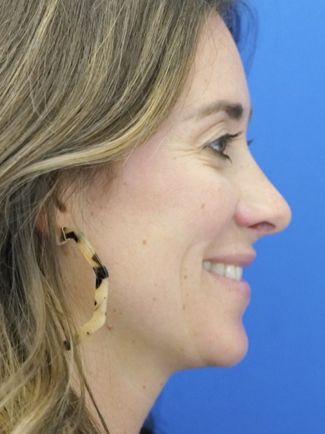 Preservation Rhinoplasty — After