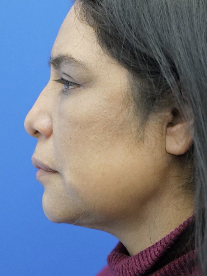 Four-Lid Blepharoplasty — After