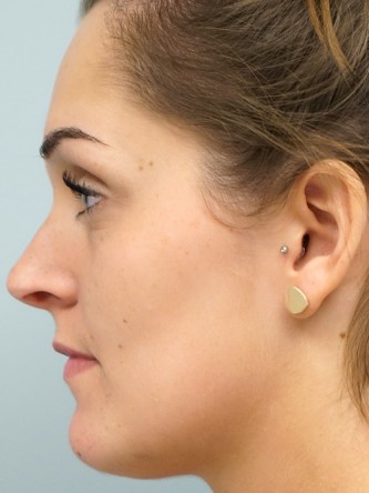 Nasal Septal Perforation1* — Before