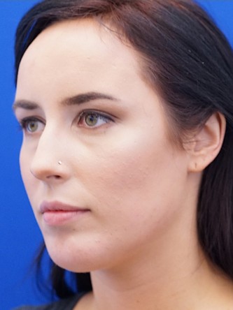 Chin Implant and Upper Lip Filler* — After