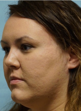 Crooked Nose Endonasal Technique2* — After