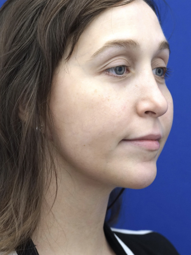 Necklift Subplatysmal Lipectomy — After