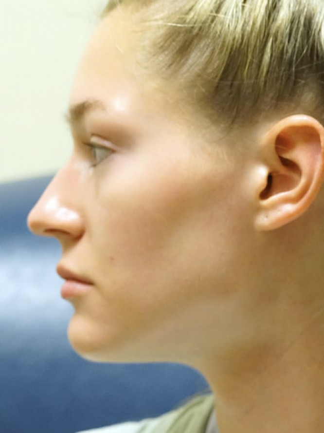 Nasal Profile Plasty — Before