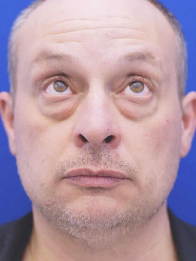 Orbital Fat Reposition — Before