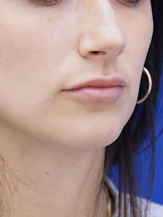 One Year Lip Filler Result — After