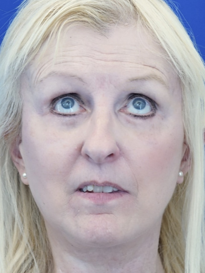 Subciliary Blepharoplasty Fat Reposition — After