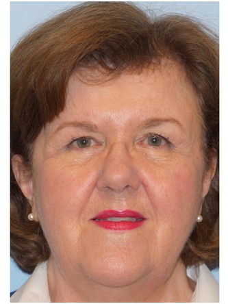 Upper Eyelid Skin Excess2* — Before