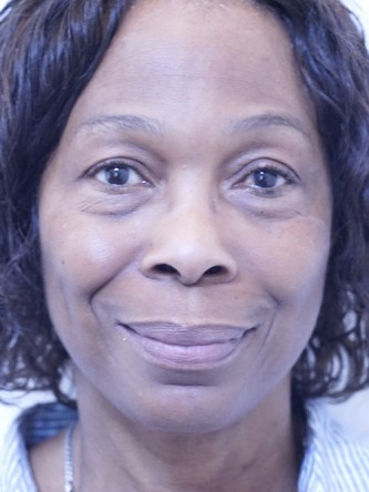 Tear Trough Under Eye Enhancement — Before