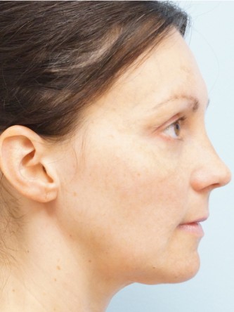 Fractional CO2 Laser Skin Resurfacing2* — Before