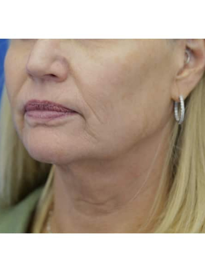 Crisp Profile Lines — Before
