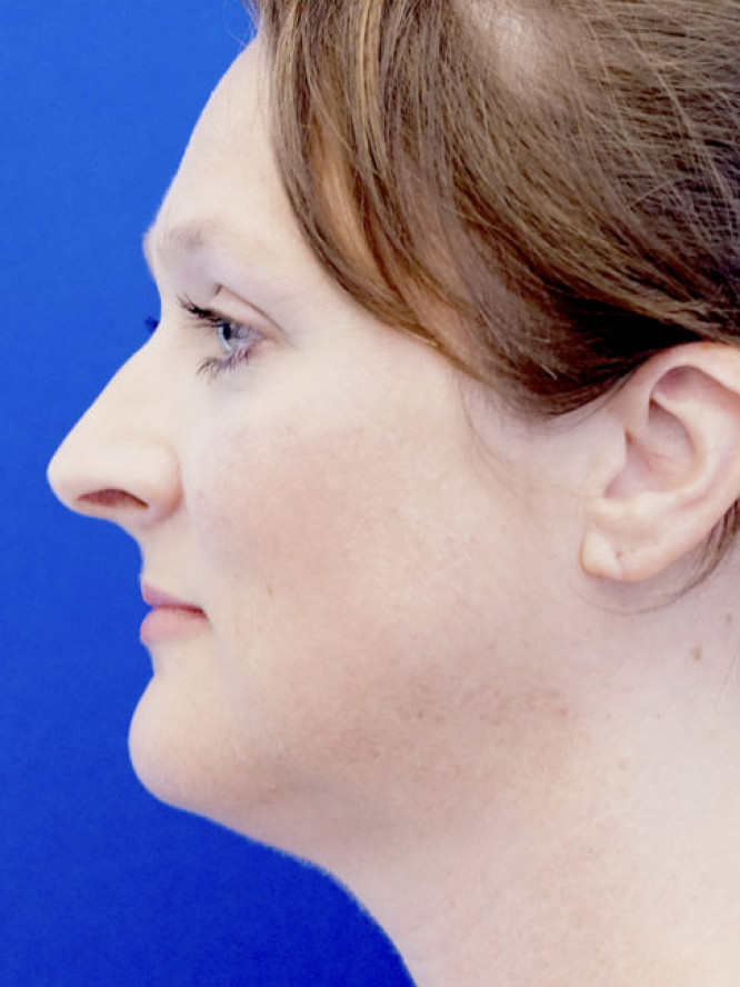Nasal Profile Femininity — Before