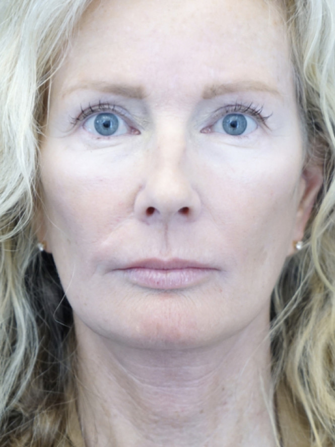 Scintillating Natural Result — After