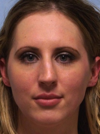 Crooked Nose & Cartilage Deformity1* — Before