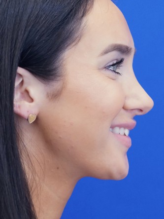 Nasal Hump Closed Rhinoplasty — After