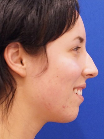 Chin Implant and Upper Lip Filler* — Before