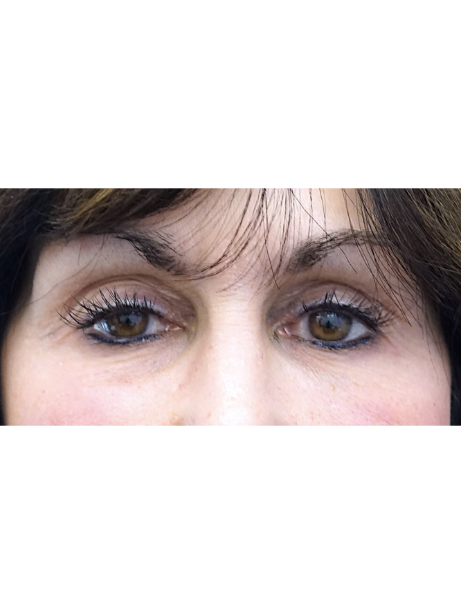 Refresh Upper Eyelid Fold — Before