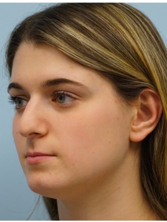 Droopy Tip Endonasal Rhinoplasty* — Before
