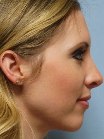 Crooked Nose & Cartilage Deformity1* — After