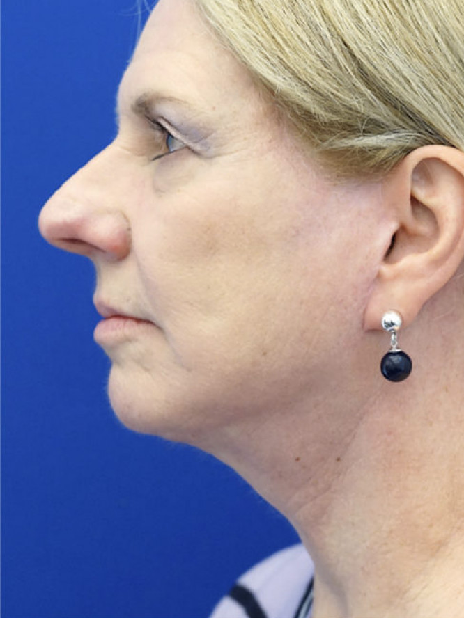 Lower Facial Aging and Fullness — After