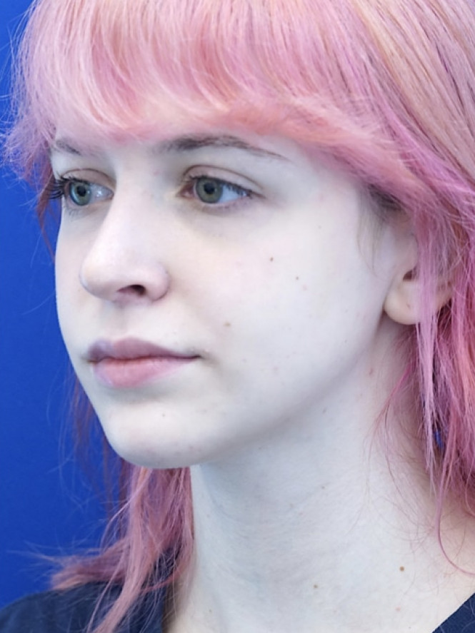 Long Droopy Tip — After