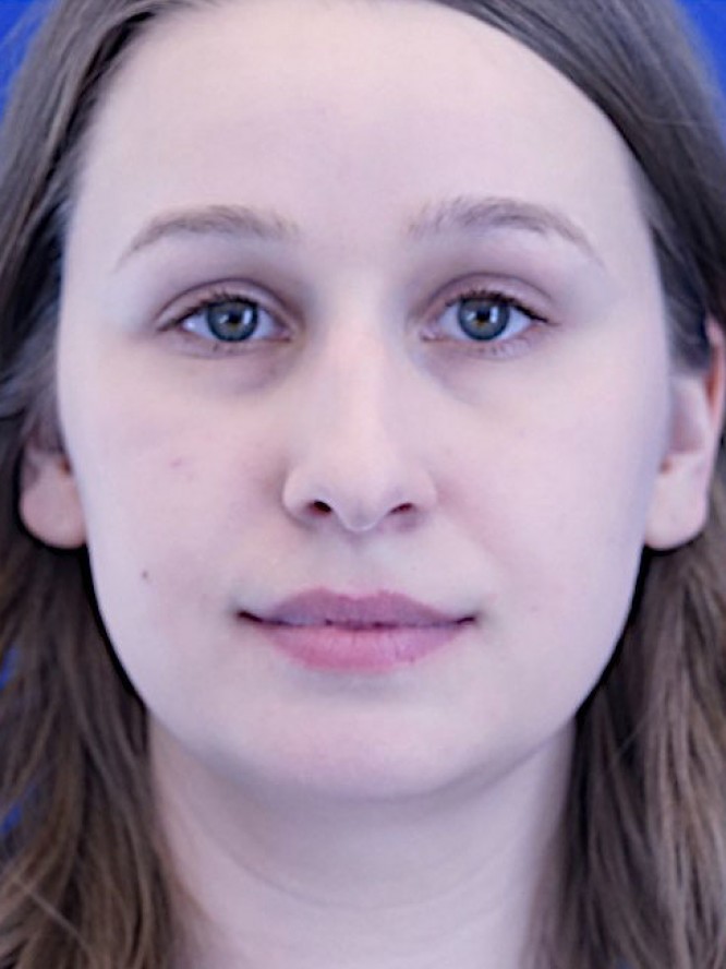 Facial Profile Plasty — Before