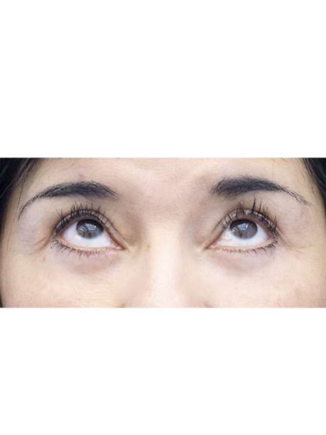 Four Quadrant Blepharoplasty with Fat Reposition — After