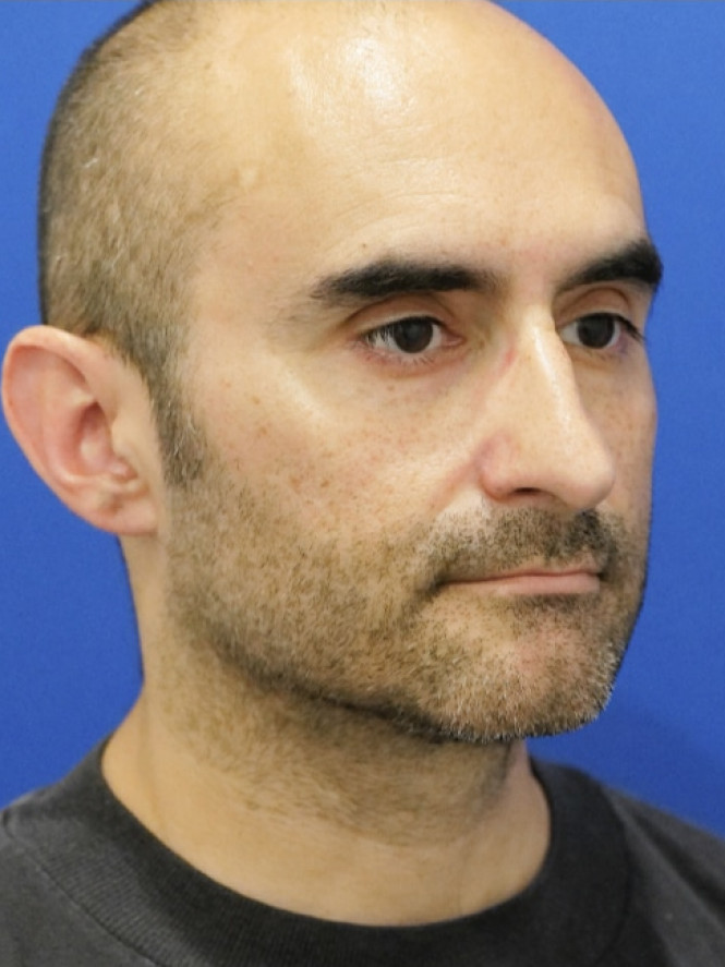 Tension Tip Ptosis — Before