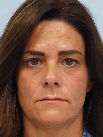 Glabellar Botox and Filler* — Before